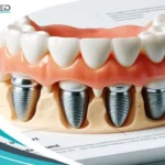 dental implants in Turkey